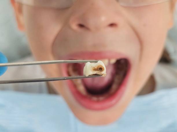 Best Broken or Chipped Tooth Repair in Northbrook, OH
